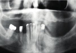 Mild to moderate horizontal and vertical bone resorption patterns, with bilateral posterior sinus pneumatization.