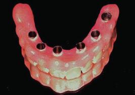 Post-op panoramic radiograph (OPG) immediately after implant placement shows the successful maxillary treatment with six Nobel Biocare