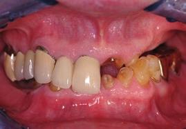 Oral examination: Unstable occlusion, extensive decay with several unrestorable teeth; periodontal status was fair, with mild to moderate periodontal pocketing and mobility.