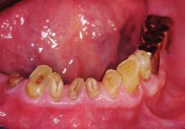 The patient requested and consented to removal of remaining teeth with full-arch implant restorations in both