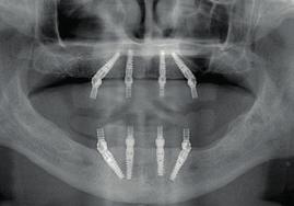 Because sufficient initial stability was achieved with each implant, provisional restoration of each arch