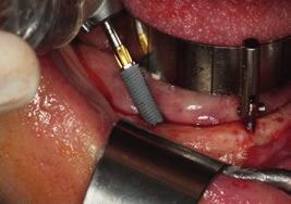 After traditional treatment planning in the mandible, a conventional flap procedure was done. The All-on-4 Guide was positioned to facilitate implant placement.