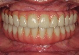 The dentures were converted into fixed all-acrylic bridges and were delivered with Temporary Copings Multi-unit Titanium.