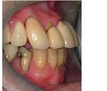 Displacement of the premaxillary alveolus and remaining maxillary teeth anteriorly due to tongue thrusting habit consistent with Tardive Dyskinesia, resulting in labial incompetence at rest.
