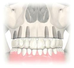 bridge Planning Maxilla Treatment example Group 2 Surgical solution All-on-4 treatment