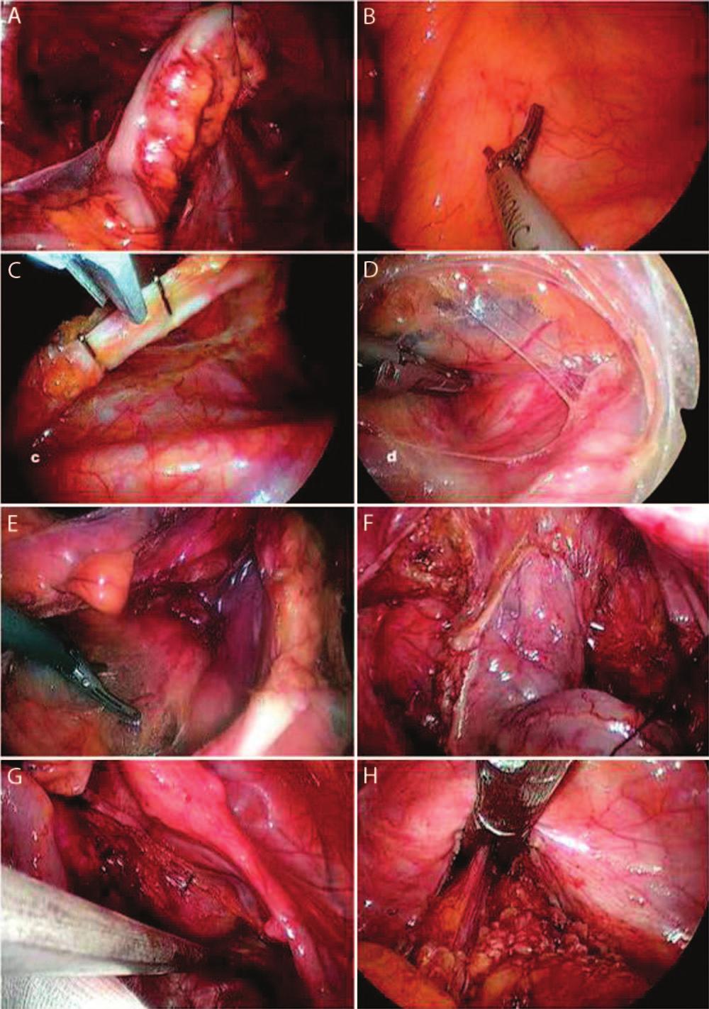 DISEASES OF THE COLON &RECTUM VOLUME 54: 7 (2011) 805 FIGURE 2. Abdominal view on postoperative day 1. FIGURE 1. A, Suspension through transparietal sutures of the rectosigmoid colon.