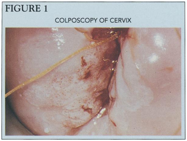 Colposcopic patterns are consistent with (choose one): Immature squamous metaplasia; Low-grade SIL; High-grade SIL; Micro-invasive cancer. QUESTION #9 QUESTION #6 1. 2. 3. 4.