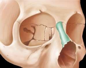 Bone (Right) Anterolateral View