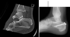 Page 5 of 8 (Left) A displaced fracture of the calcaneus. (Right) The fracture has been reduced and the bones held in place with screws.