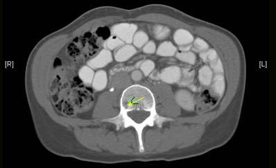 Companion Patient #1: Hemangioma on CT CT with IV and oral contrast Revealed a mass with