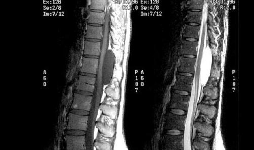 Companion Patient #2: Arachnoid on MRI T1-weighted Revealed a hypointense signal of a well-circumscribed mass that was compressing the spinal cord.