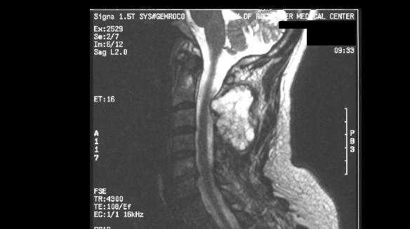 Companion Patient #3: Chondrosarcoma on MRI T2 Sagittal with contrast Demonstrates a large, wellcircumscribed mass compressing the spinal cord.