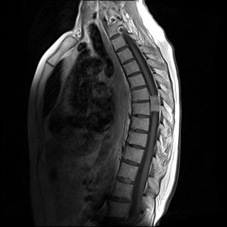 Patient HD DURAL TAIL T2 Axial Post-gadolinium contrast