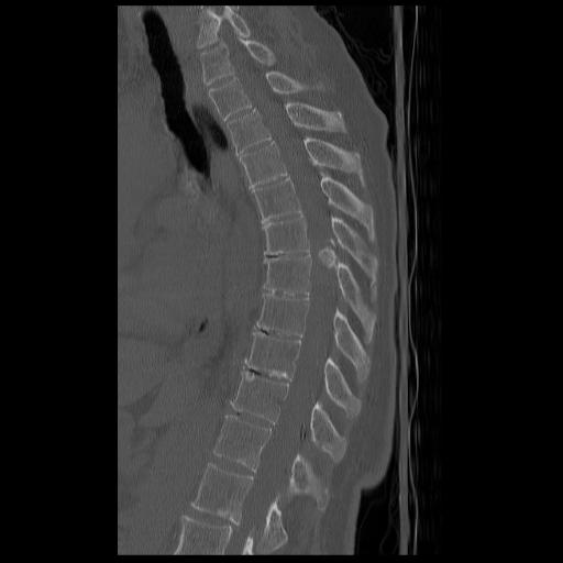 Patient HD CT Sagittal Reformatted Calicifed component of the intradural