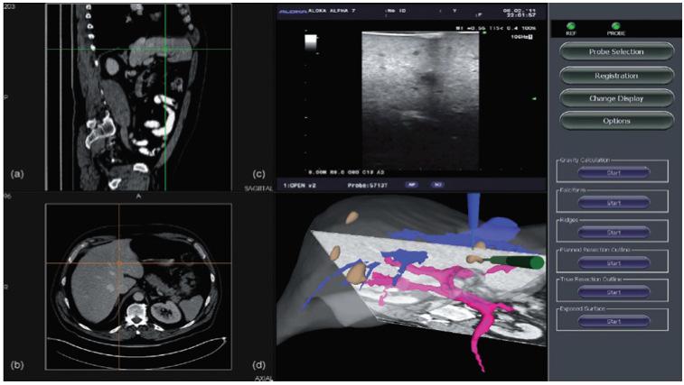 intraoperative rigid registration, (e) tracking of Ultrasound transducer, and (f) interrogation of liver surface with tracked