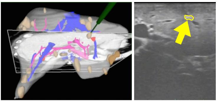Figure 4. Tumor successfully located with guided ultrasound: (left) green probe indicates tumor in CT on the imageguidance display and (right) yellow arrow indicates tumor.