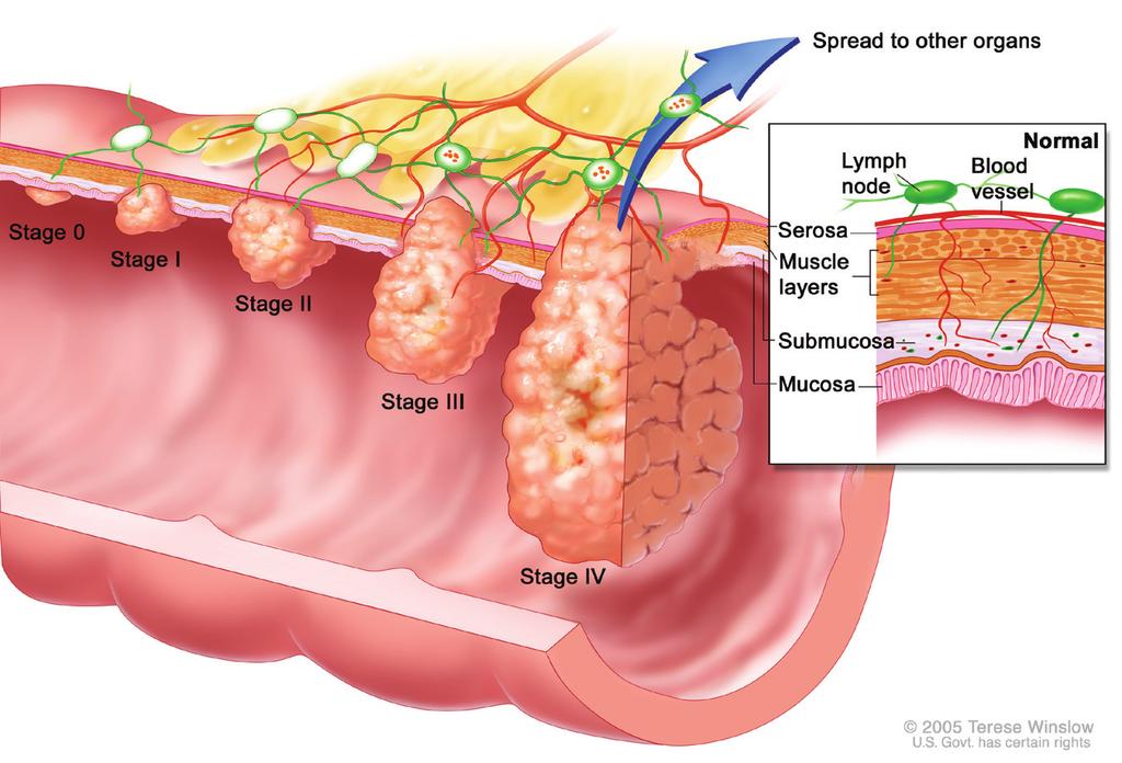 Tell me about colorectal cancer The wall of the colon and rectum has four main layers (see Figure 2).