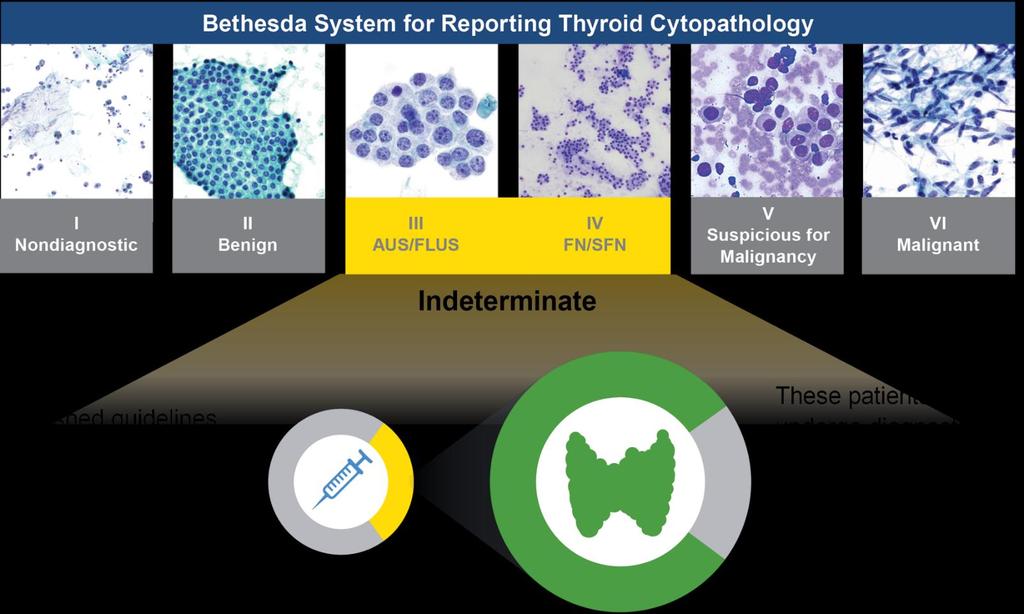 FNA Cytopathology: Avoid diagnostic thyroid surgery is the goal ATA Recommendation #9 FNA