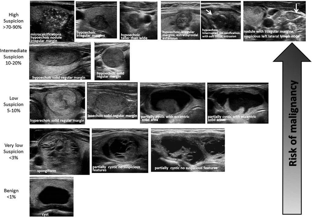 ATA Ultrasound Stratification Haugen BR et al.