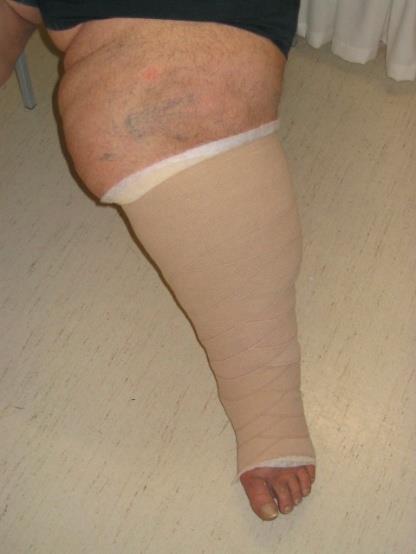 Compression Therapy distension superficial veins