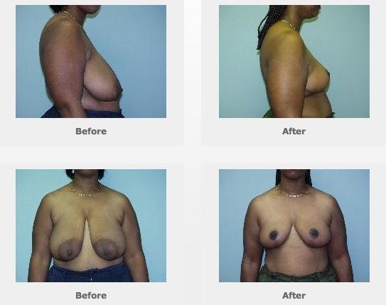 Breast Reduction Surgery Houston THE PROCEDURE Breast Reduction Surgery Houston A Breast Reduction is performed in an accredited surgery center under general anesthesia.