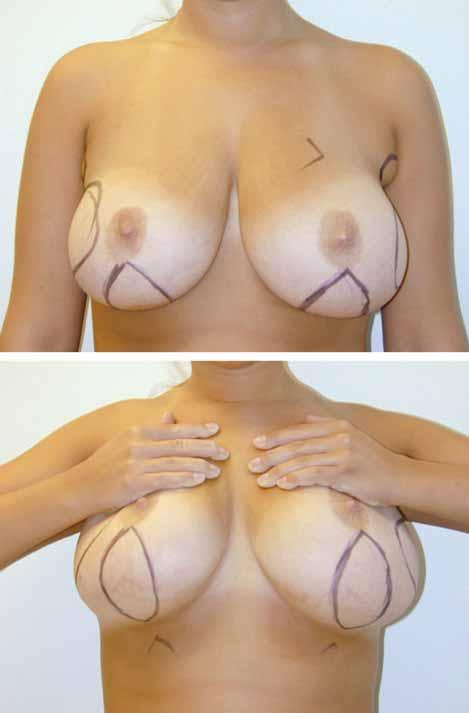 Volume 129, Number 1 Repeated Breast Reduction Outcomes Fig. 2. (Left) A superior pedicle is used to transpose the nippleareola complex. A sagittal section (SS) through the breast is marked.