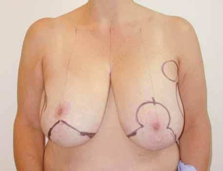 She had significant breast asymmetry, including the location of her nipple-areola complexes.
