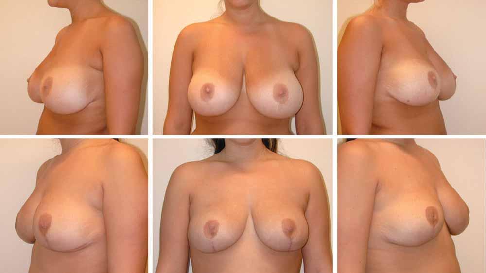 Volume 129, Number 1 Repeated Breast Reduction Outcomes Fig. 6.