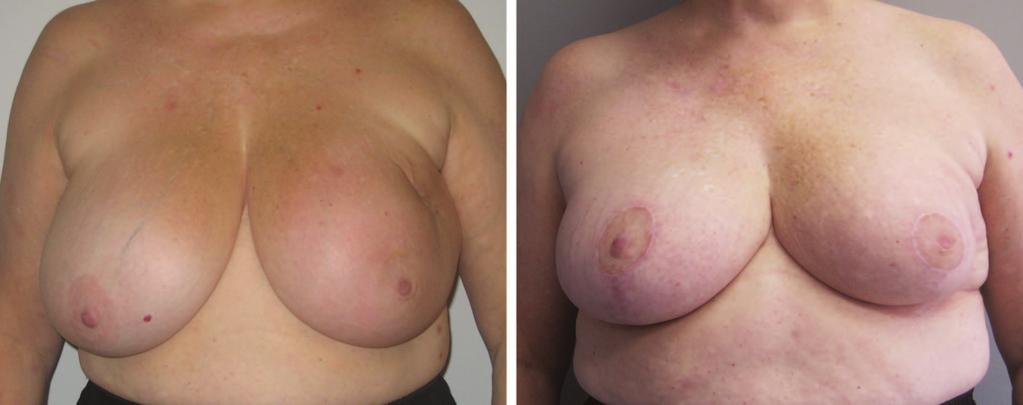 Plastic and Reconstructive Surgery June 2011 Fig. 2. Case 2. (Left) A 63-year-old woman was found to have abnormal calcifications within the left breast.
