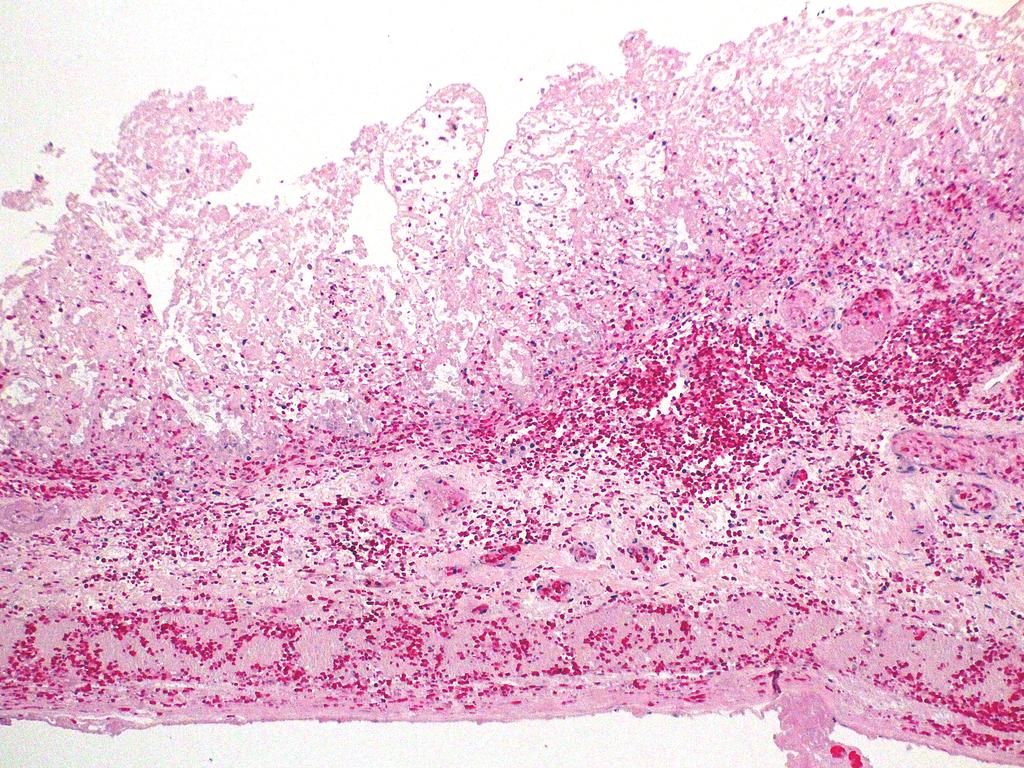 378 Hizuru Amano et al. Fig. 3 Pathological findings of the paper-thin intestine (H/E stain) at second laparotomy showing full-thickness necrosis with hemorrhage.
