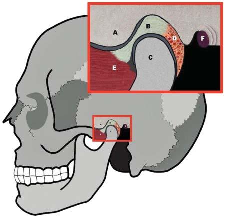A=Temporal Bone; B=Articular Disc (or just Disc); C=Condyle; D=Posterior Ligament (containing nerves and blood vessels); E=Lateral Pterygoid Muscle; F=Ear Canal THE TMJ UNDER STRESS So, how did the