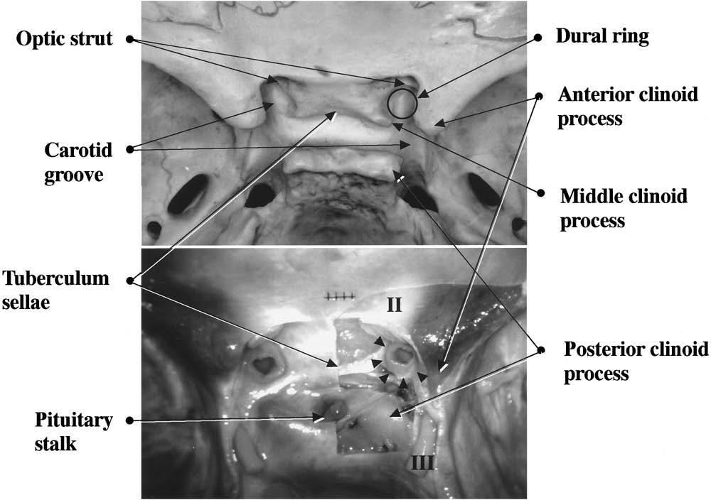 S. Oikawa, K. Kyoshima, and S. Kobayashi FIG. 3. Photographs presenting superior views of the juxta dural ring area in cadaver specimens, showing the relationship of bone and dural structures.