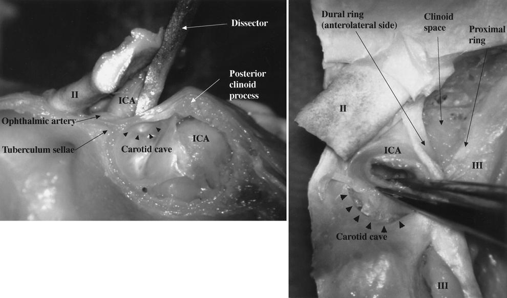 Anatomy of the juxta dural ring area FIG. 4. Photographs obtained while dissecting cadaver specimens. Left: Medial view of the right juxta dural ring area.
