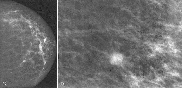 Mammography magnification views