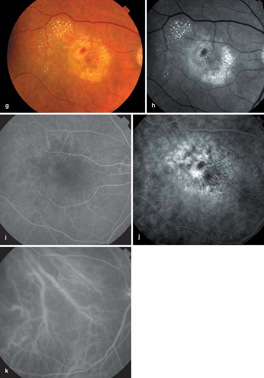 374 Fig. 2a k Case 15: stage 2 CRA before and after PDT. a, b Redfree and color photographs: a ring of lipid exudates, neurosensory detachment, intraretinal small hemorrhages.