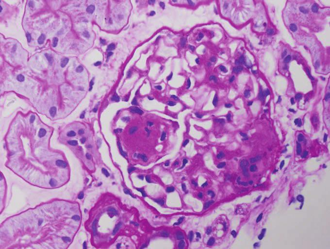 No specific glomerular staining is identified for albumin, fibrinogen, C1q, or IgM. There is staining of few tubular casts for both light chains, IgM, and IgA.