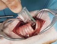 Tracheostomy In laryngeal