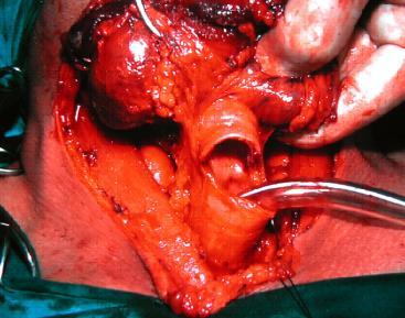 tracheal stoma  carcinoma