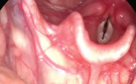 laryngeal pathology seen in school