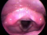 Laryngopharyngeal Reflux (LPR) Hoarseness Globus Dysphagia Chronic cough