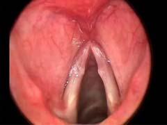 Benign Vocal Fold Lesions Almost always traumatic, irritative, or overuse/abuse Vocal nodules Polyps Cysts Scars Surgery usually performed with microsurgical technique Vocal Nodules Rough voice with