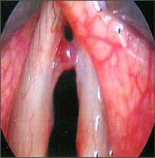 Vocal Polyp Sudden onset of hoarseness after extreme voice use, with persistent rough, raspy quality Unilateral polyp, dark and filled with blood Vocal Polyp- Treatment Stop any