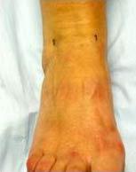 This is also known as anterior ankle arthroscopy.