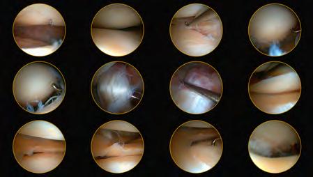 ARTICULAR CARTILAGE INJURY Articular cartilage lines the ends of our joint surfaces and is composed of cells called chondrocytes, along with a matrix of proteins and collagen.