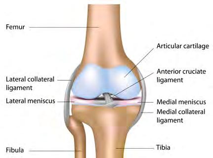 Meniscal Allograft Transplantation represents a solution to a symptomatic, meniscal deficient knee, which has not reached an advance stage of osteoarthritis.