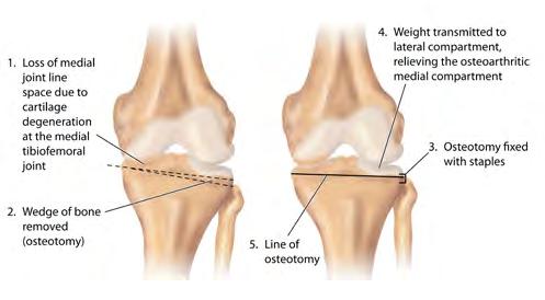 KNEE ALIGNMENT & OSTEOTOMY SURGERY MALALIGNMENT Proper alignment of the knee is essential for normal function and balance of the joint.