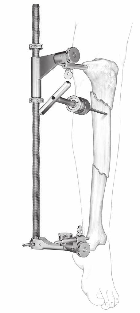 The distractor will help to keep the fracture out to length and aid