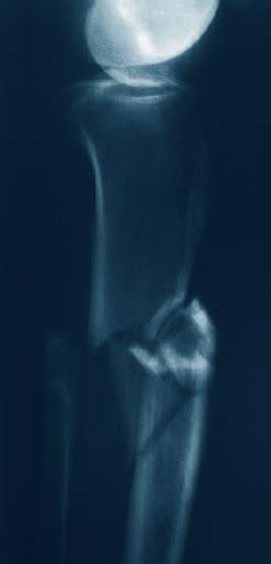 Case Examples CASE 2 Fracture