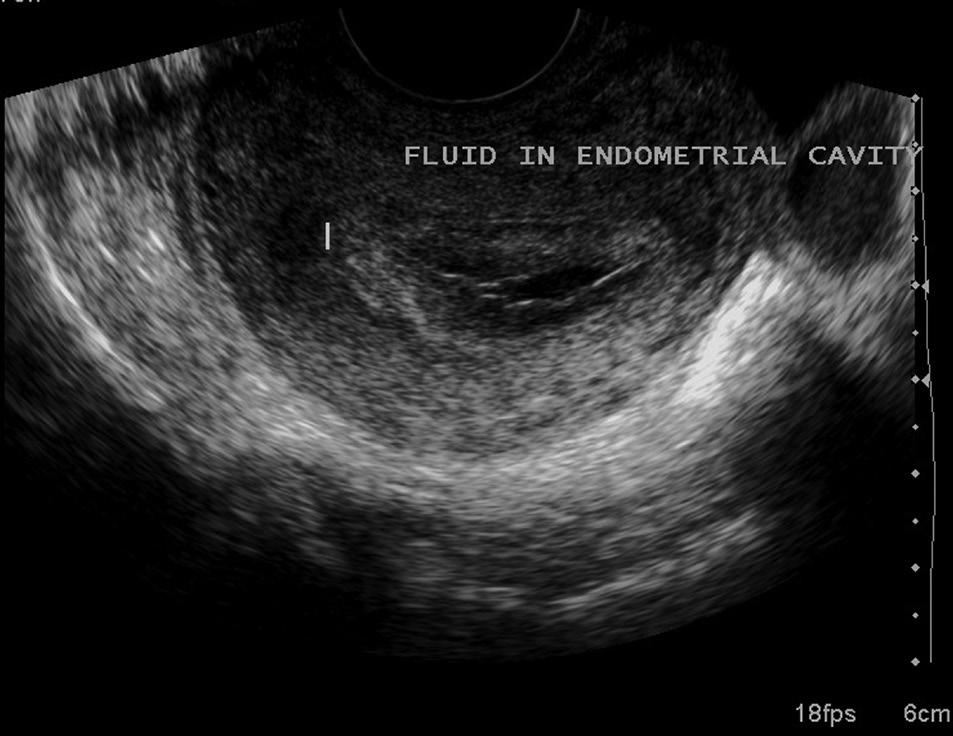 l successful pregnancy with an endometrial thickness as little as 4 mm. [9] In our study, the thinnest endometrial lining for successful ongoing pregnancy was 5.