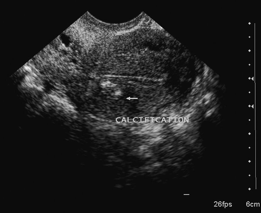 With increasing endometrial thickness (>14 mm), a high miscarriage rate was reported by Weissman, [10] which was not observed in the present study.